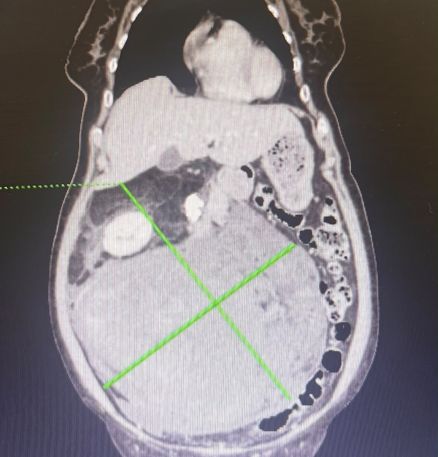 Case Study: What Seemed Like Persistent Gas Turned Out To Be A 30-cm Rare Cancer Occupying Most Of Her Abdomen
