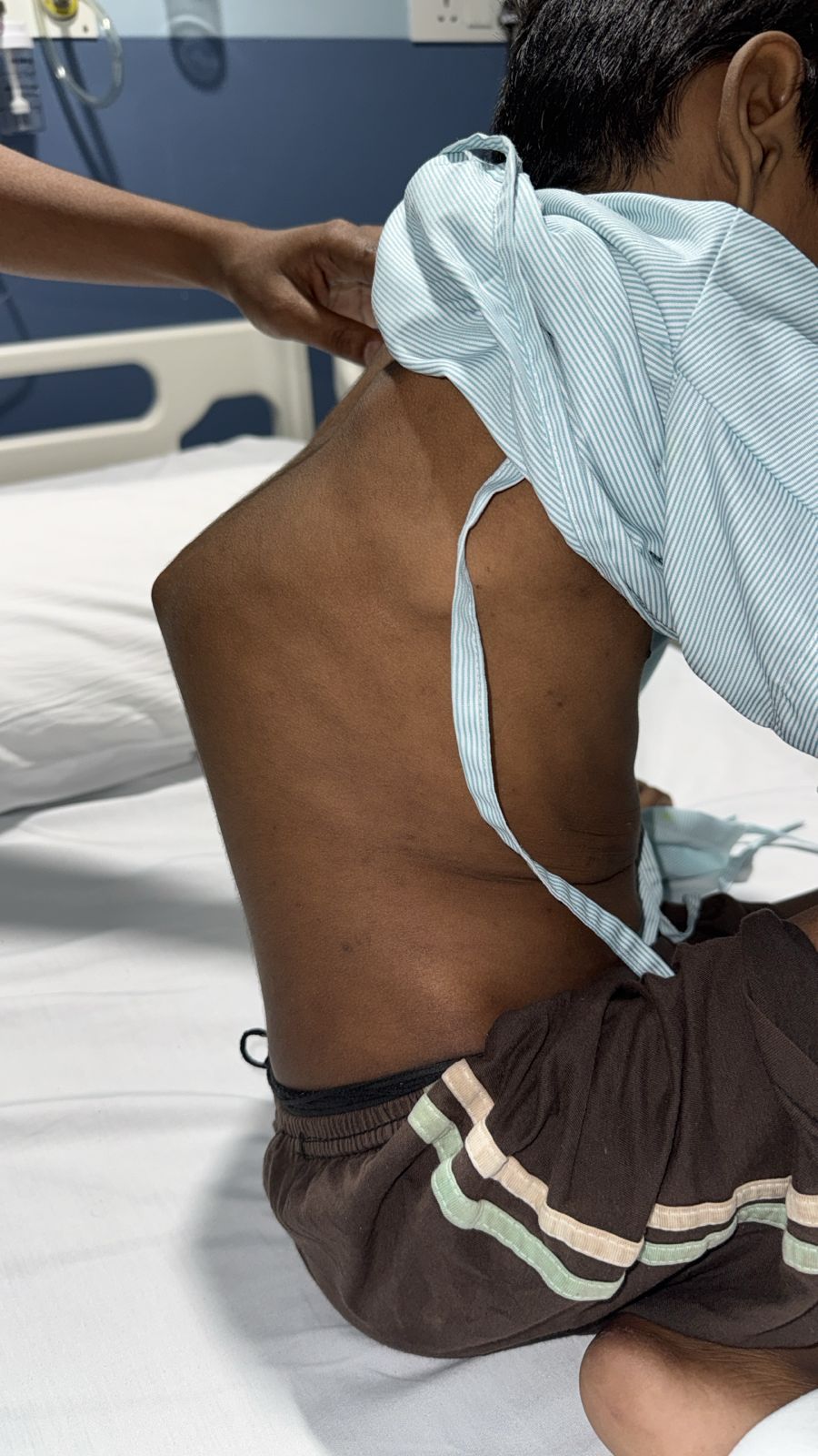 8-Year-Old Boy Walks Again After High-Risk Surgery for Advanced Spinal Tuberculosis