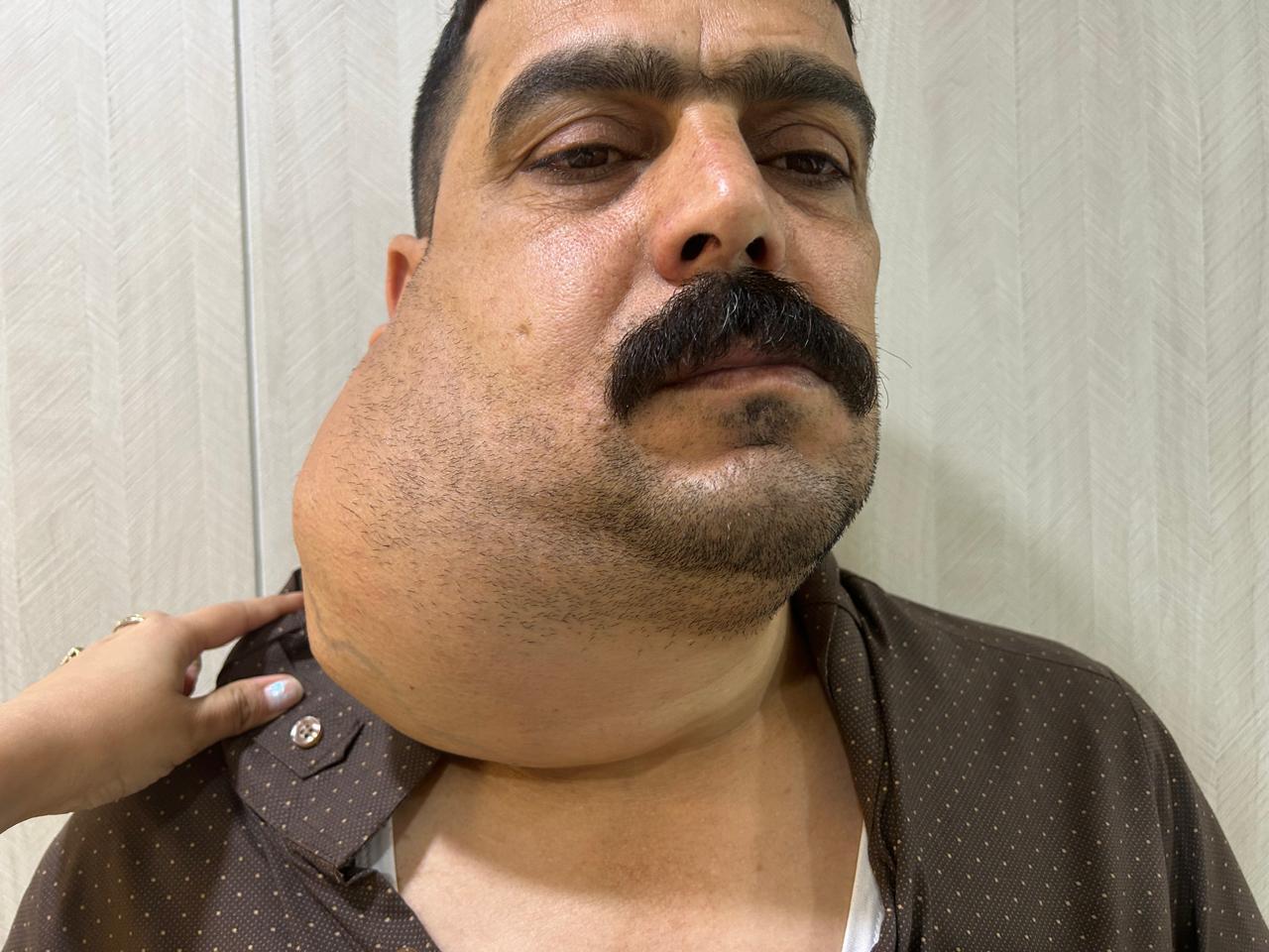 Rare Giant Neck Tumour Left 43-Year-Old Unable to Sleep Lying Down for 2 Years; Fortis Gurugram Doctors Restore His Relief