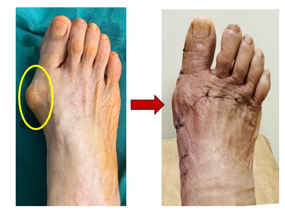 Apex Hospital in Borivali Brings Advanced Minimally Invasive Bunion Surgery to Mumbai&rsquo;s Suburban Area