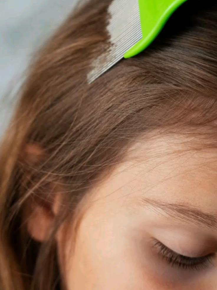 Lice-Free Hair: Step-by-Step Removal and Protection Guide
